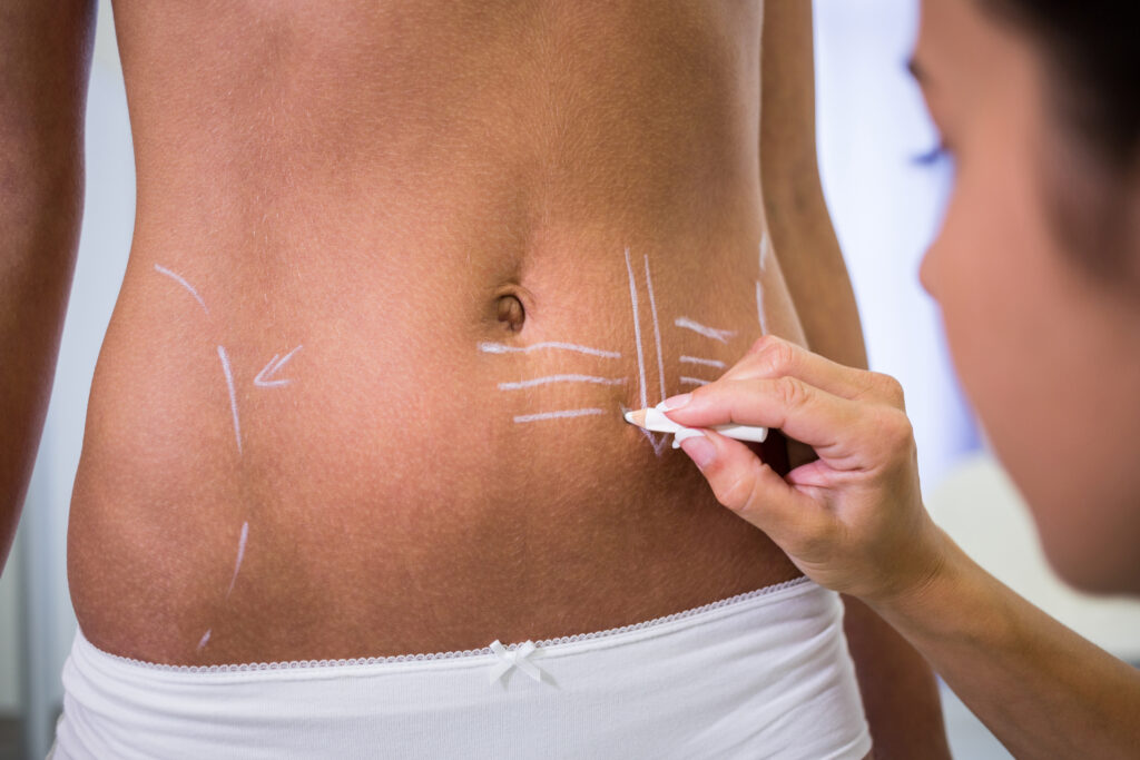 liposuzione laser: come eliminare le adiposità