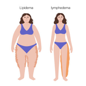 differenze tra linfedema e lipedema