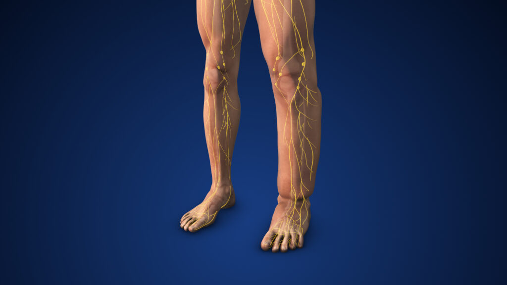 linfedema