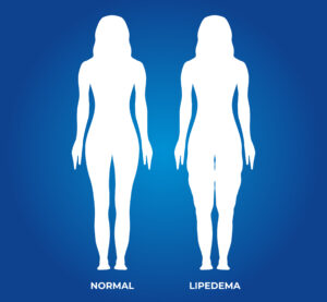 lipedema