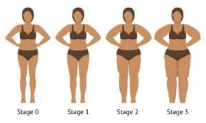 stadi del lipedema