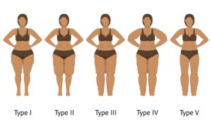 tipologie di lipedema