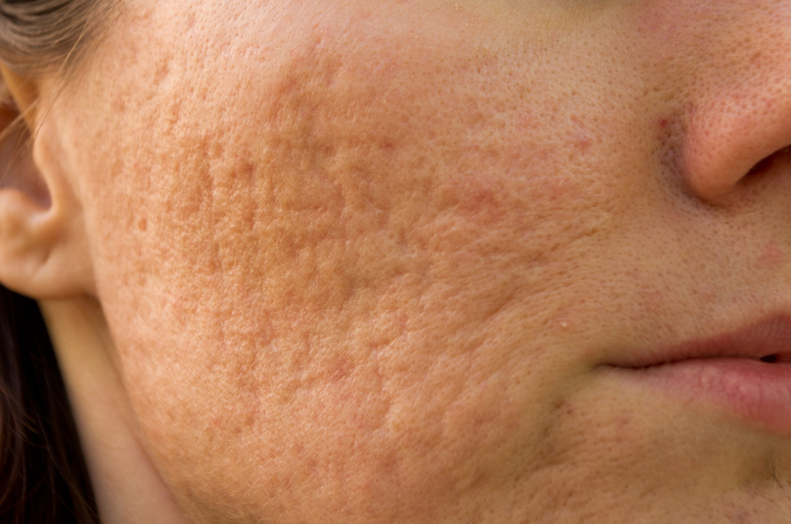 Trattamento delle cicatrici da acne con laser CO₂ frazionato