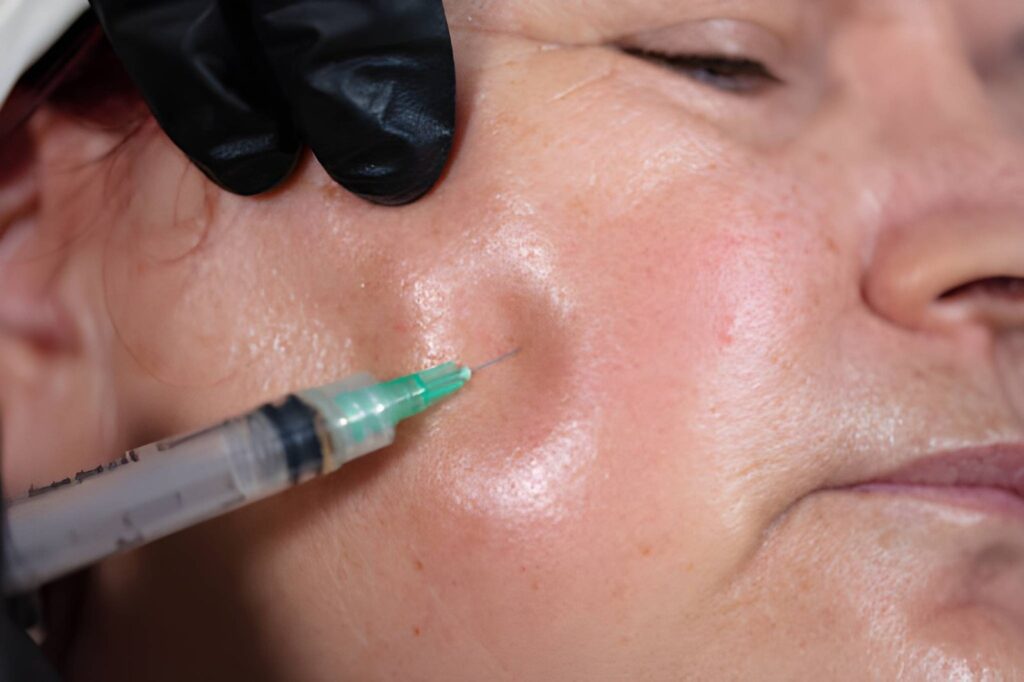 Granuloma filler