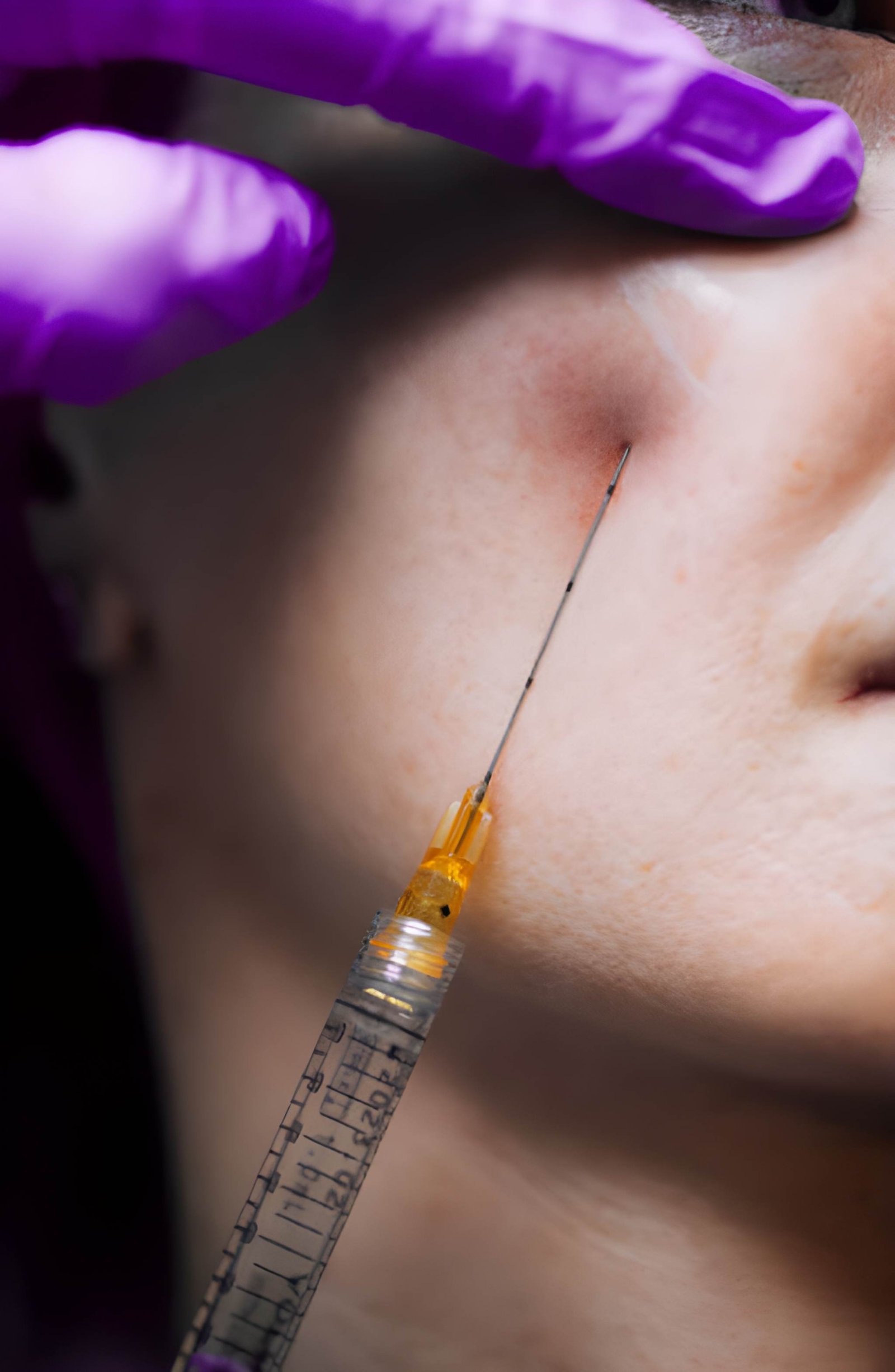 Granuloma Filler